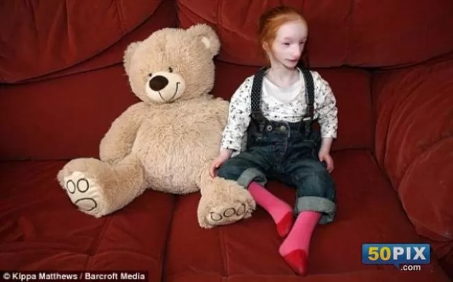 صور - الطفلة العفريت | يخشى الجميع إيذائها بدون قصد وتوقع الأطباء موتها!