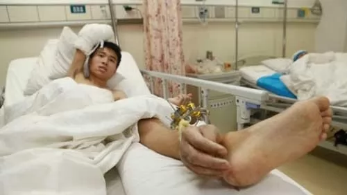 صور - غرائب العالم - انقاذ يد رجل عن طريق دمجها في ساقه