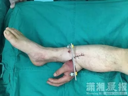 صور - غرائب العالم - انقاذ يد رجل عن طريق دمجها في ساقه