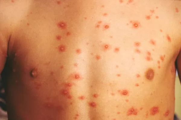 صور - انواع العدوى الفطرية للجلد