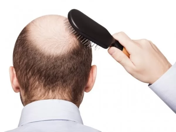 hoppe Saucer Fejlfri يجزم الموئل غبار كيفية منع تساقط الشعر للرجال - oregonpaternityproject.org