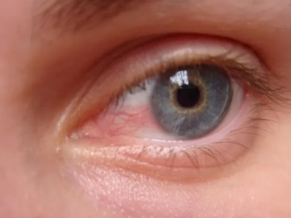 صور - ما هى اسباب امراض العيون ؟