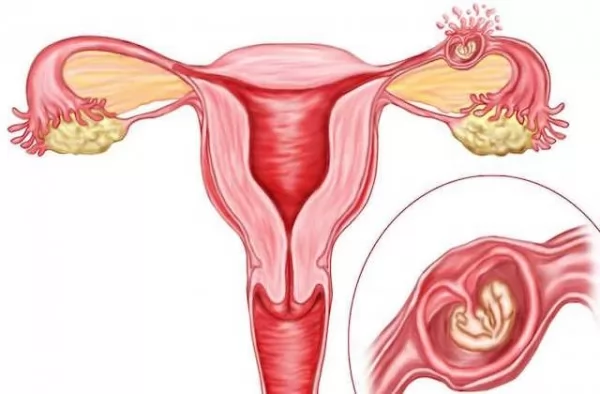 صور - اسباب واعراض وعلاج الحمل خارج الرحم