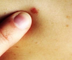 7 طرق طبيعية لعلاج البقع الحمراء على الجلد