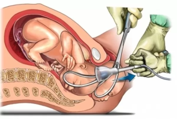 استخدام ملقط الولادة في العملية القيصرية